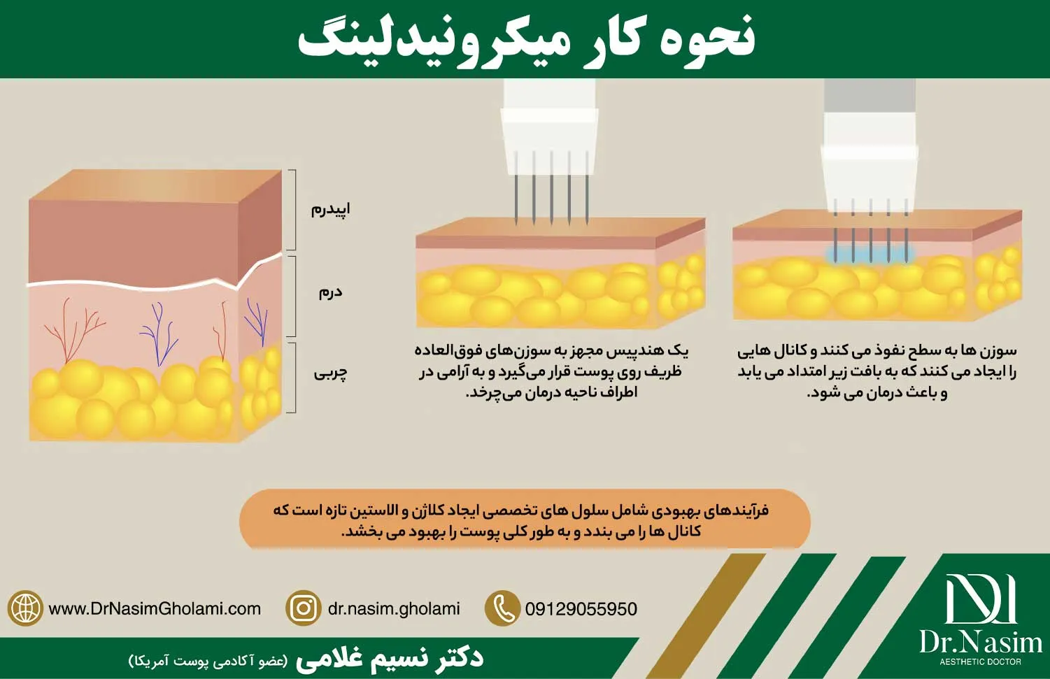 نحوه انجام عمل میکرونیدلینگ