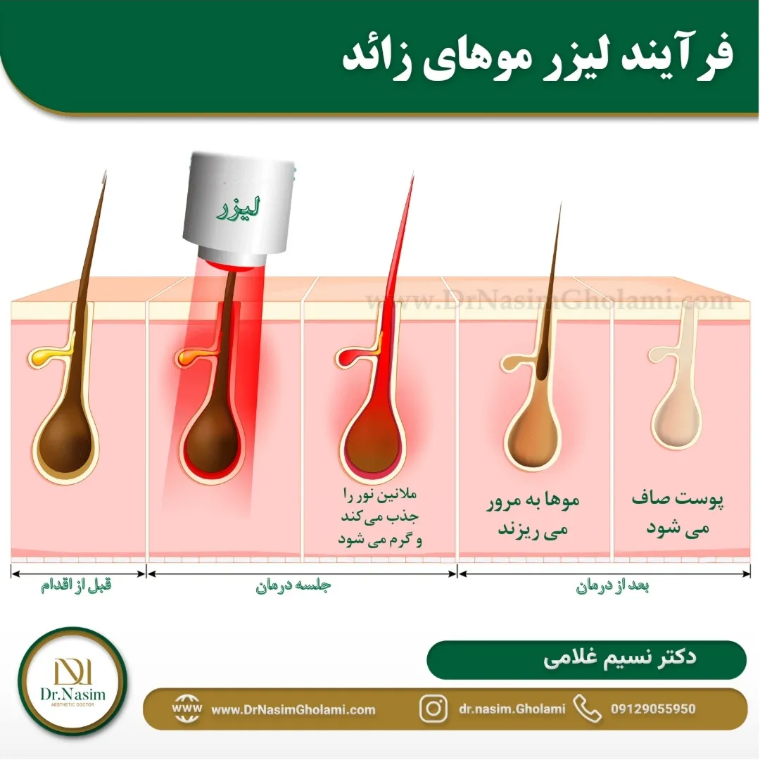 نحوه از بین بردن مو توسط لیزر موهای زائد