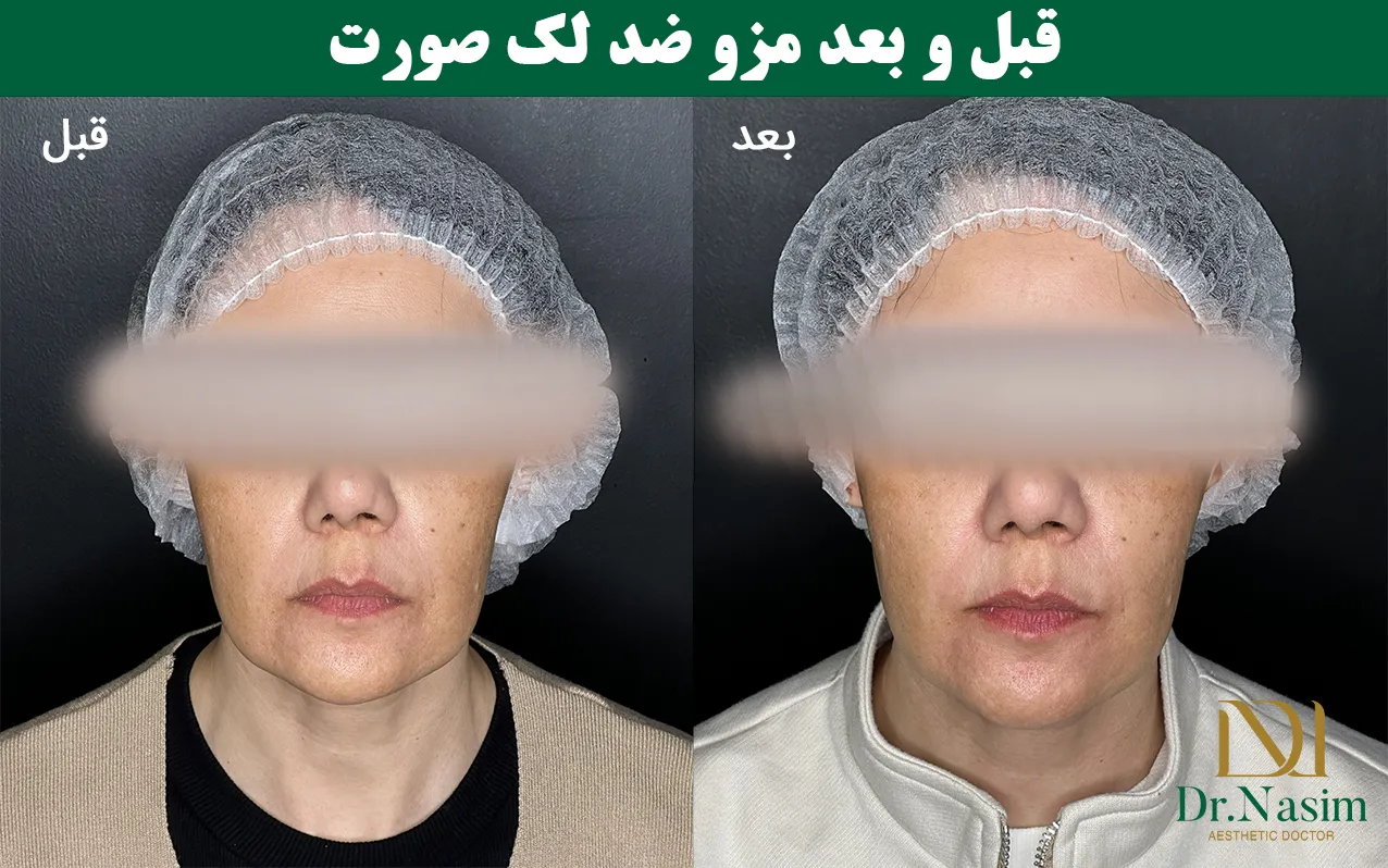 قبل و بعد از مزوتراپی برای از بین بردن لک صورت