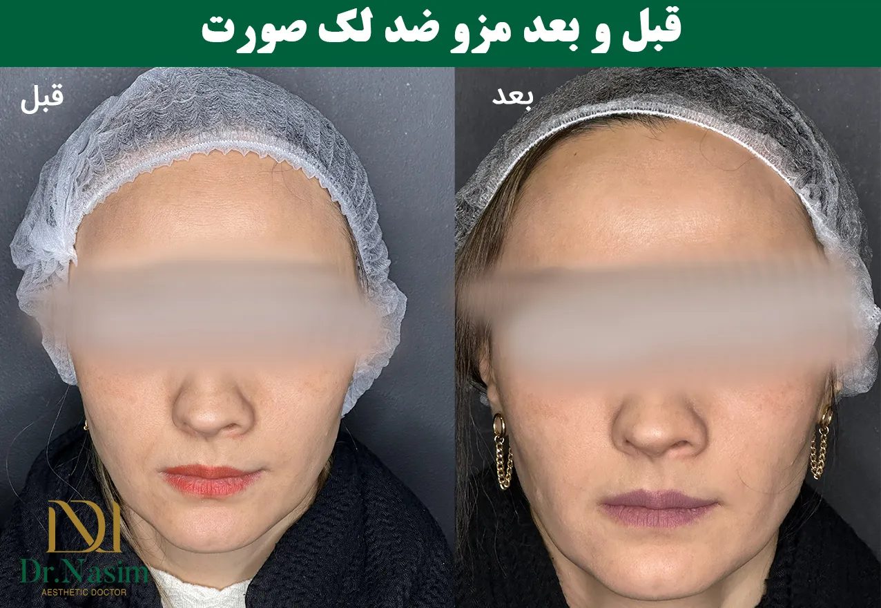 قبل و بعد از مزو ضد لک