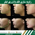 زاویه سازی فک چیست