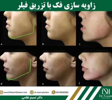 زاویه سازی فک چیست