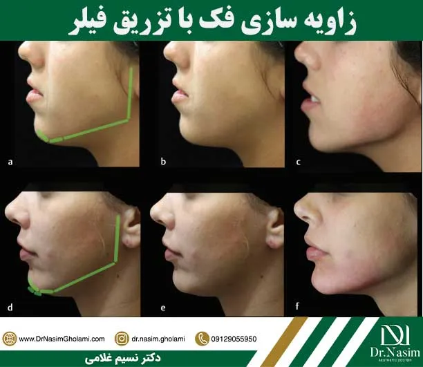 زاویه سازی فک چیست