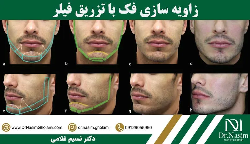 زاویه سازی فک با فیلر