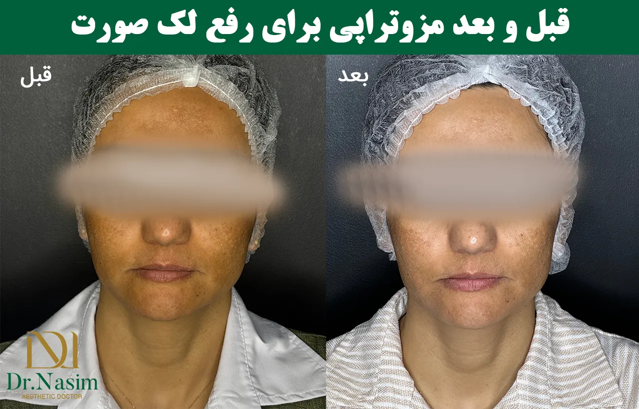 قبل و بعد از مزوتراپی برای رفع لک صورت
