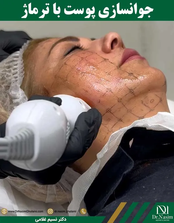 جوانسازی صورت با دستگاه ترماژ