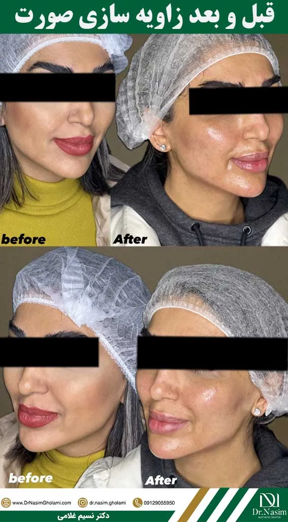 عکس قبل و بعد زاویه سازی فک