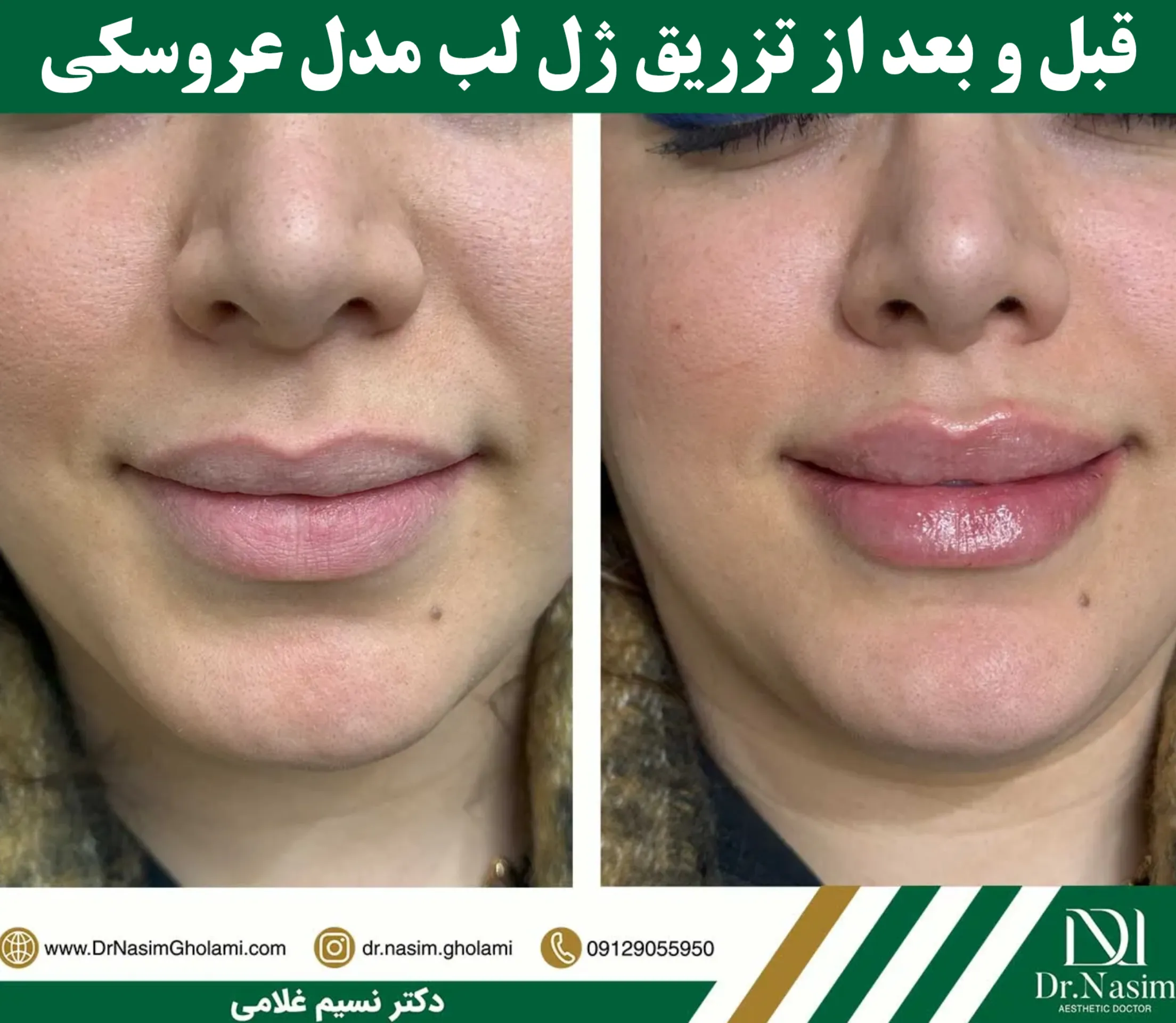 عکس قبل و بعد از تزریق فیلر لب عروسکی