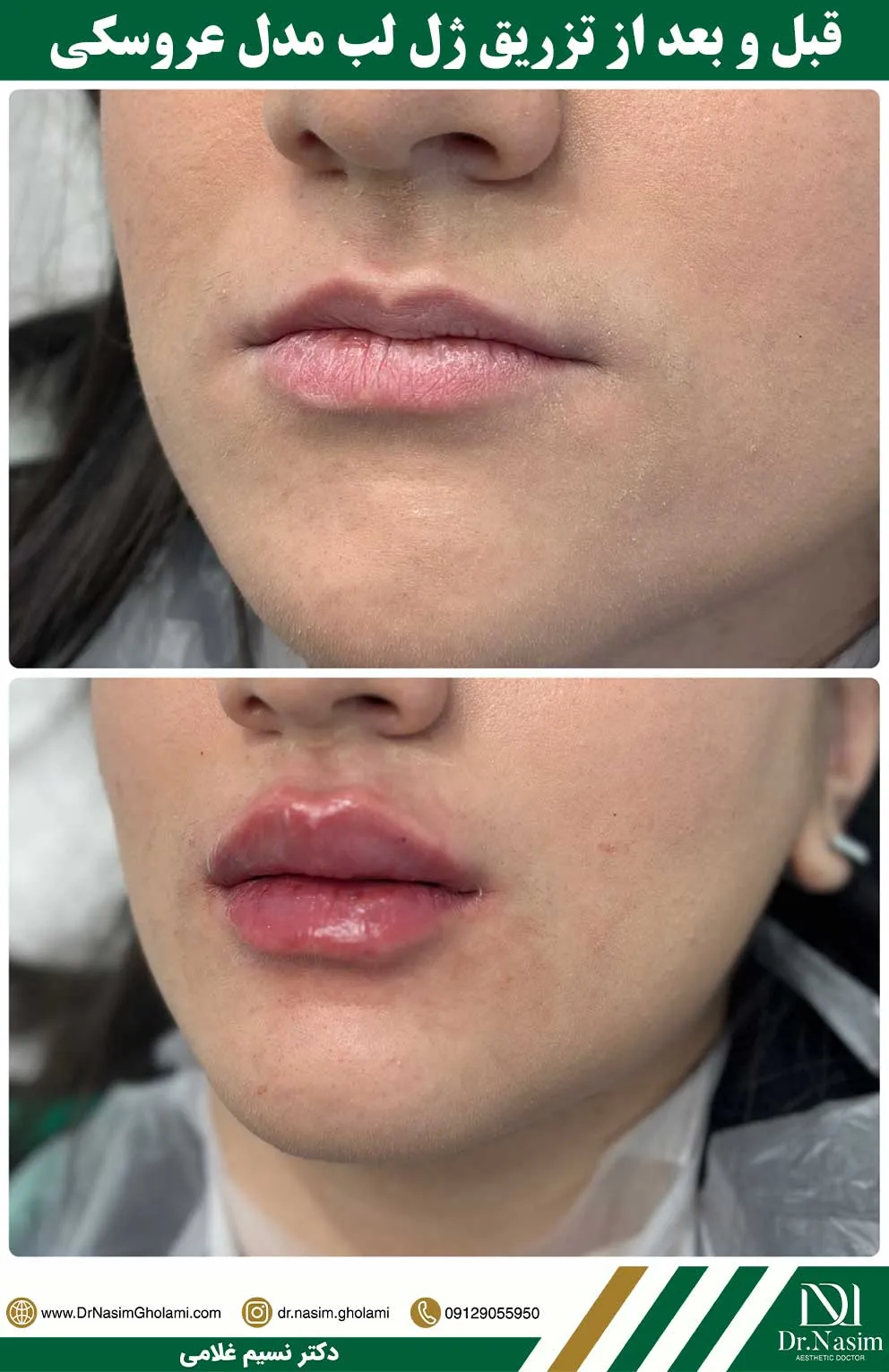 عکس قبل و بعد از تزریق ژل لب شکل عروسکی