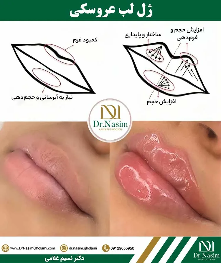 ژل لب مدل عروسکی