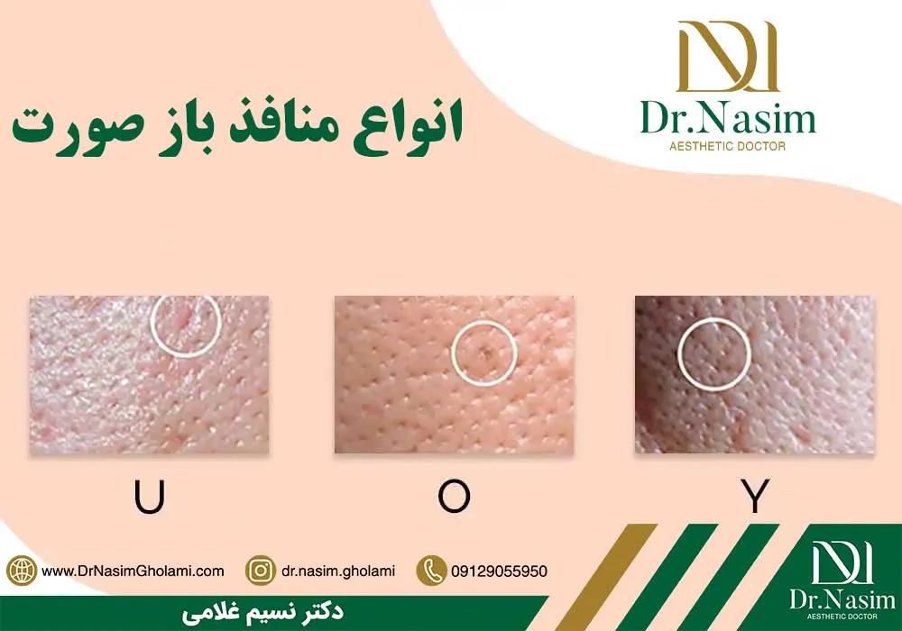 انواع منافذ باز پوست
