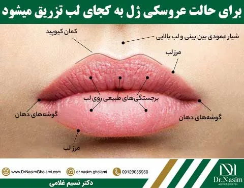 نحوه تزریق ژل لب مدل عروسکی