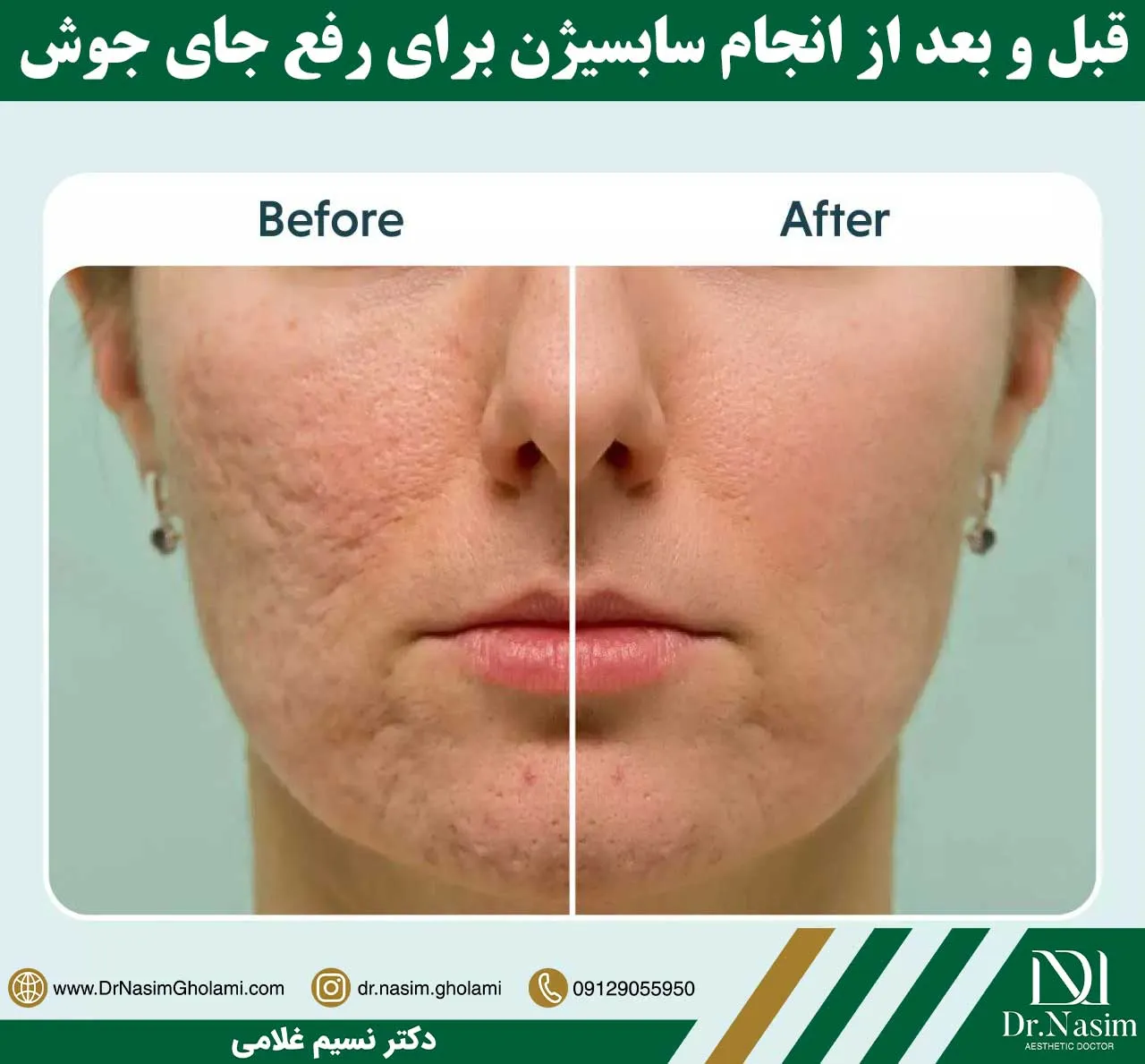عکس قبل و بعد از انجام سابسیژن برای رفع جای زخم