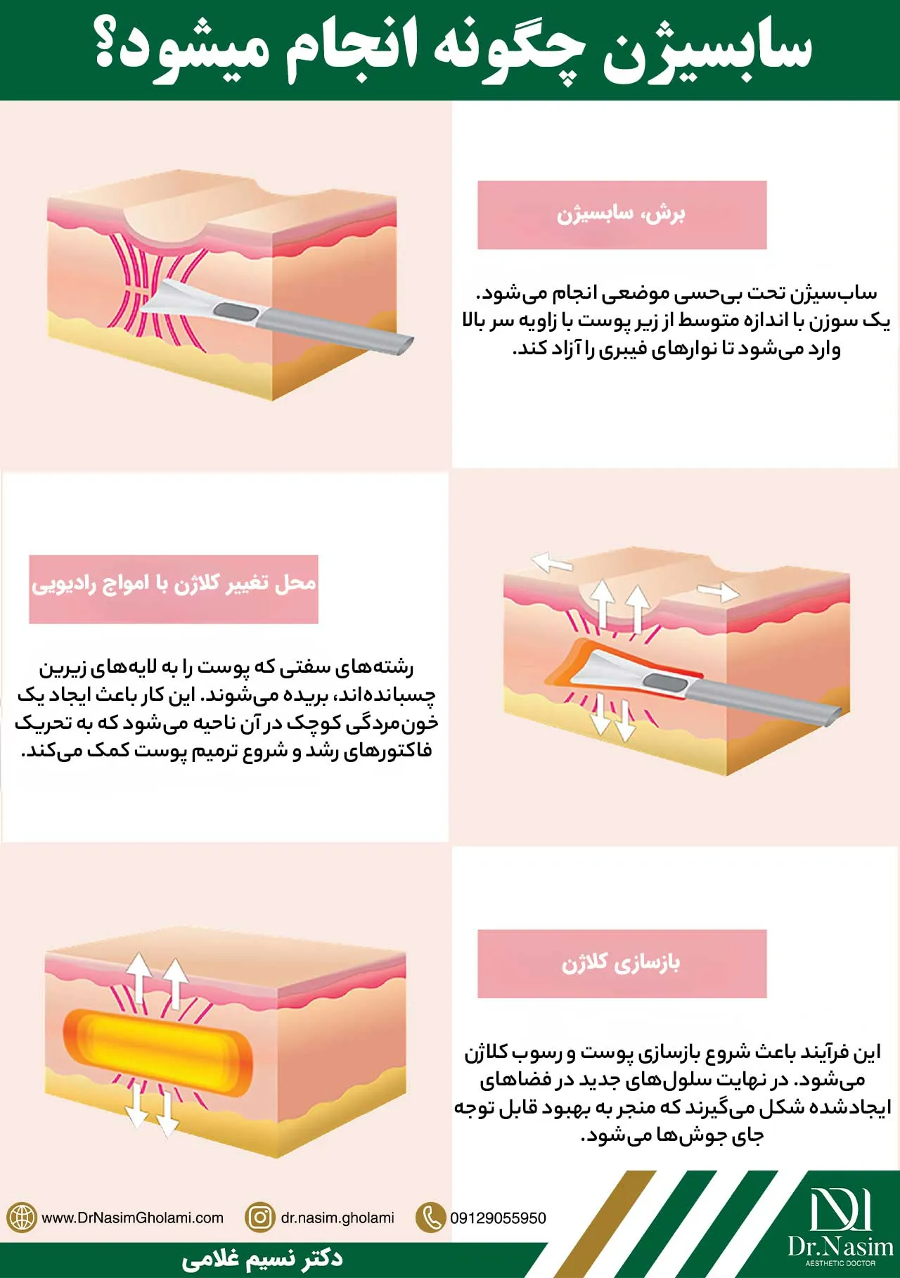 نحوه انجام سابسیژن