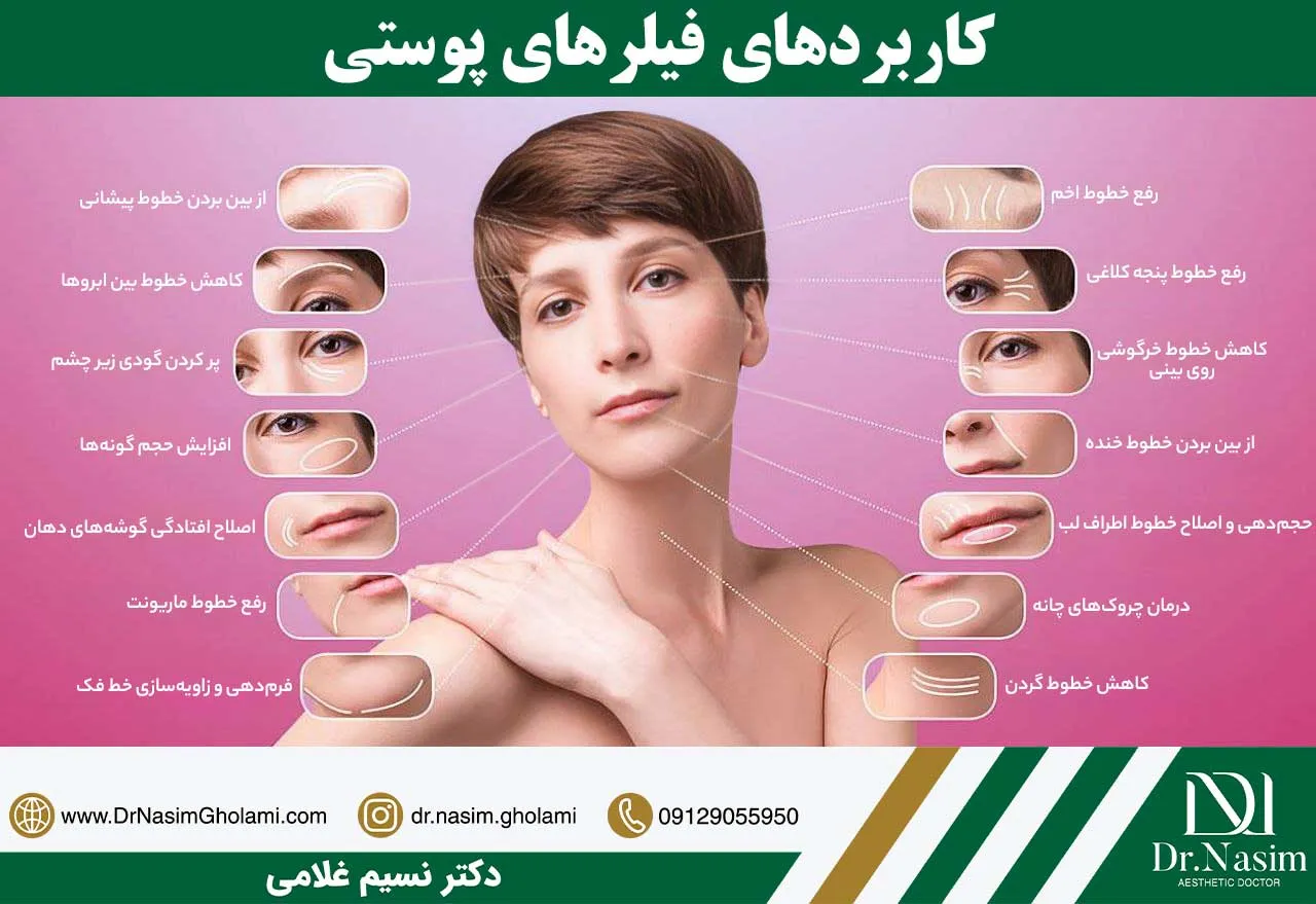 کاربردهای فیلر