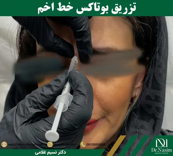 تزریق بوتاکس برای خط اخم