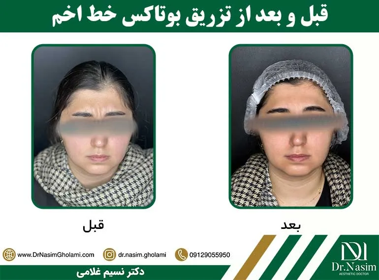قبل و بعد از بوتاکس خط اخم