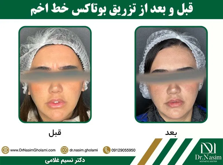 قبل و بعد از بوتاکس خط اخم