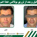 قبل و بعد از تزریق بوتاکس