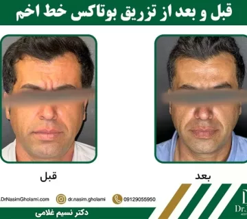 قبل و بعد از تزریق بوتاکس