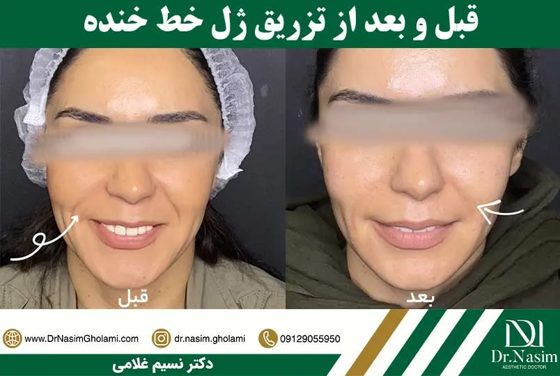 قبل و بعد تزریق ژل خط خنده
