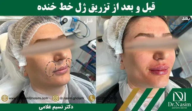 قبل و بعد تزریق ژل خط لبخند