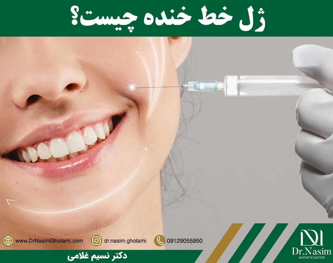 فیلر خط خنده چیست