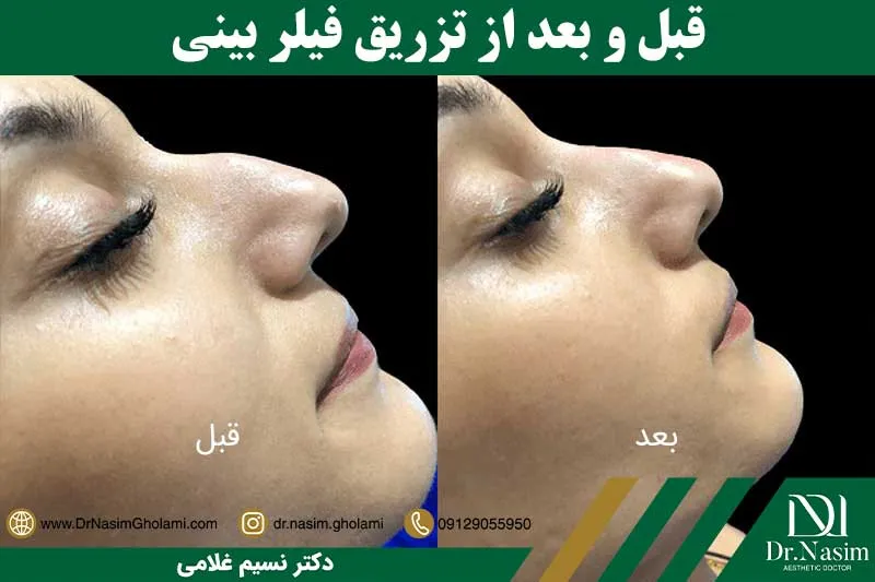 قبل و بعد از تزریق فیلر بینی
