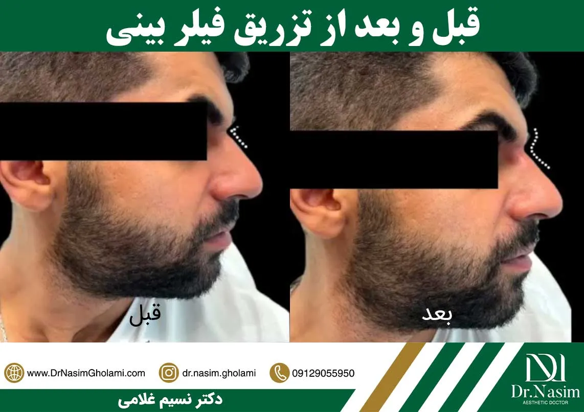 قبل و بعد از تزریق فیلر بینی برای رفع قوز بینی