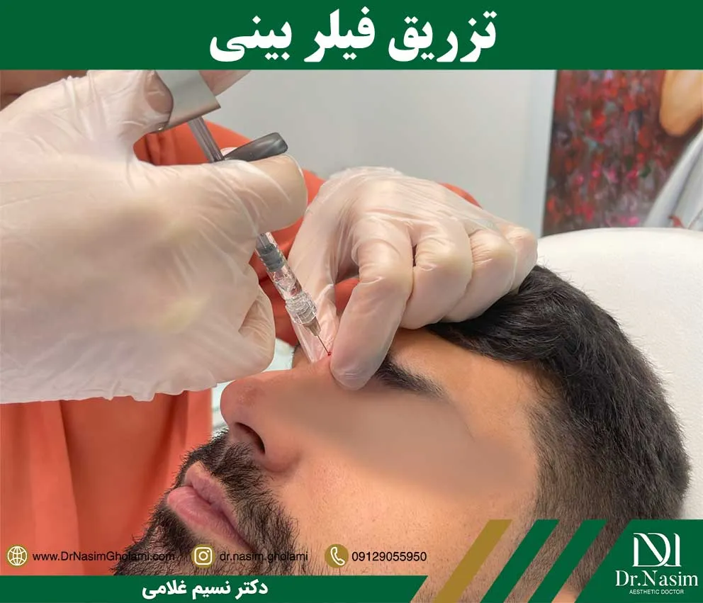 فیلر بینی چیست