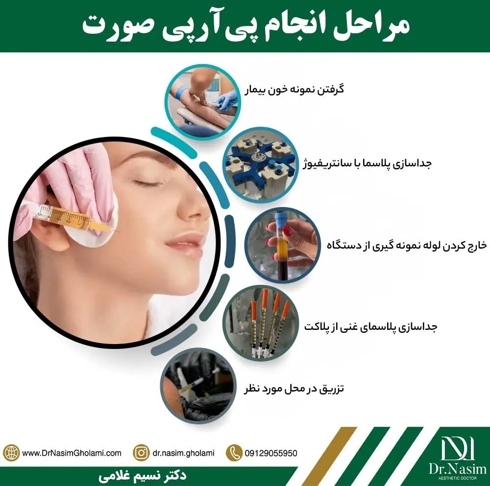 نحوه انجام prp صورت