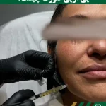 پی آر پی صورت چیست