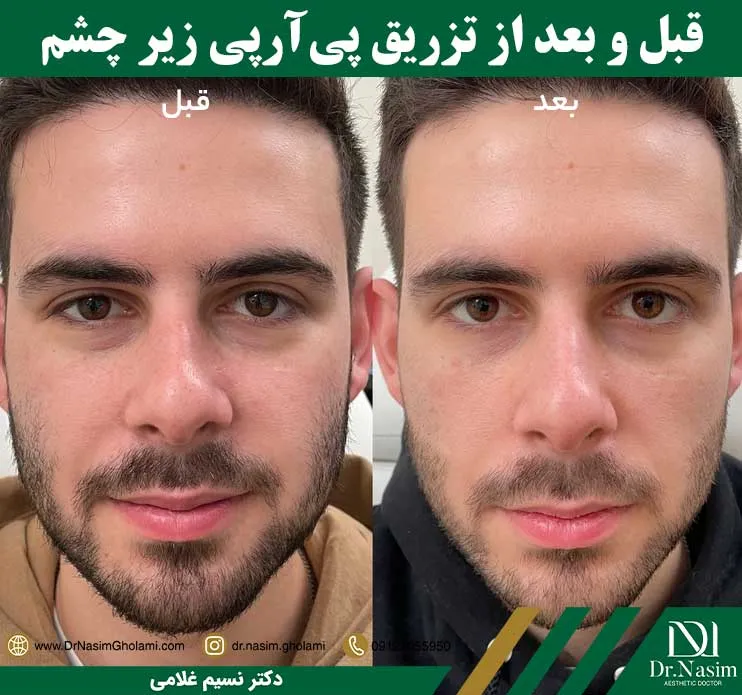 عکس قبل و بعد از پی آر پی چشم