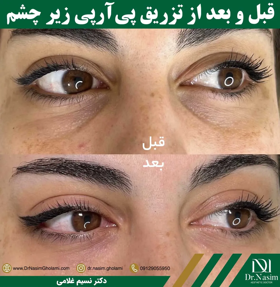 عکس قبل و بعد از تزریق پی آر پی چشم برای رفع تیرگی