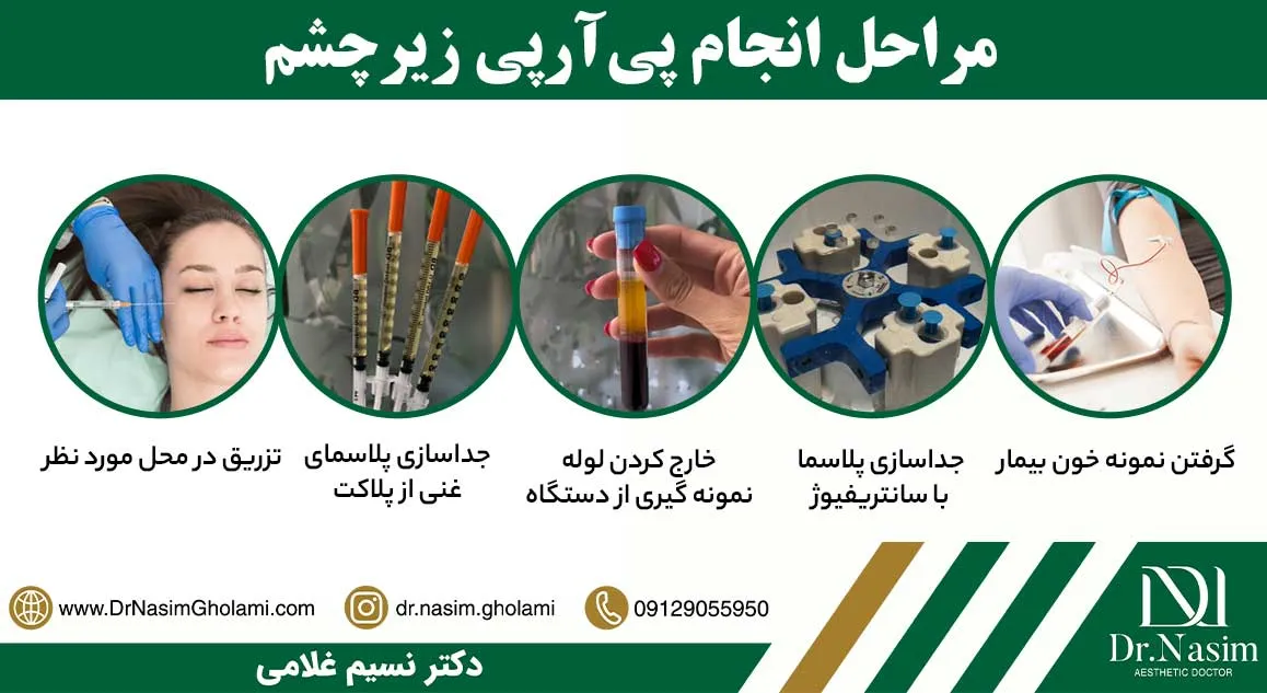 مراحل تزریق پی آر پی به زیر چشم