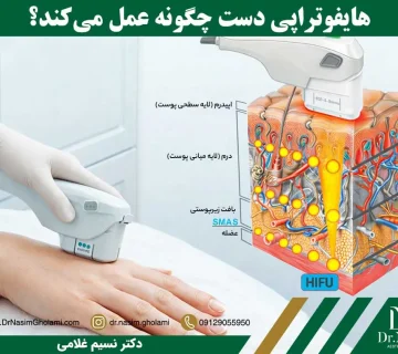 هایفوتراپی روی دست چگونه انجام می شود