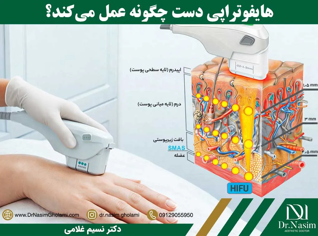 هایفوتراپی روی دست چگونه انجام می شود